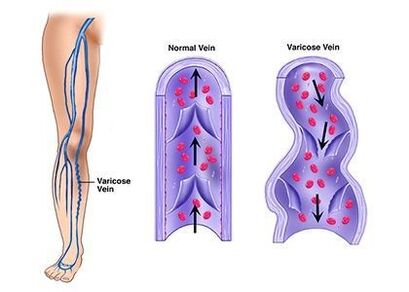 Neoveris verhindert die Entwicklung von Venenpathologien