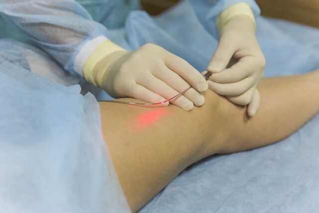 Laserbehandlung von Krampfadern