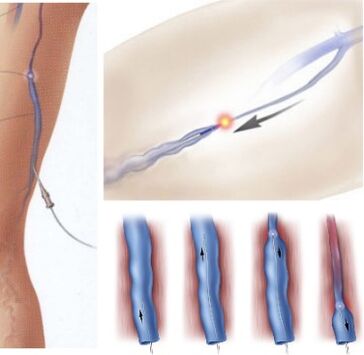 Methode zur Behandlung von Krampfadern - endovenöse Laserkoagulation