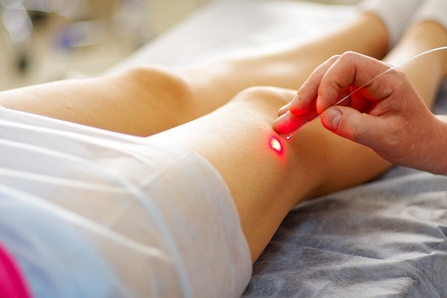 Laserbehandlung von Krampfadern