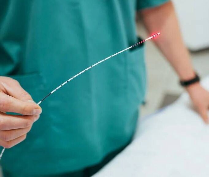 Laserablation bei Krampfadern